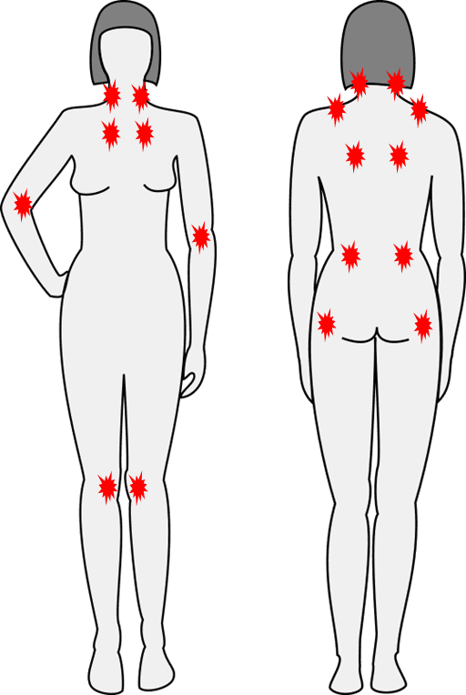 線画の女性シルエット上に線維筋痛症で発症する18箇所の圧痛点